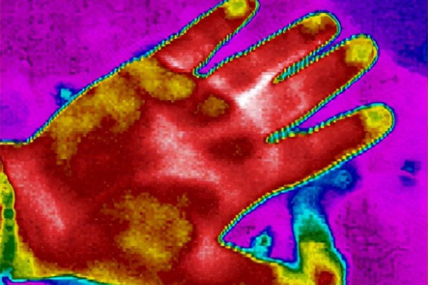 医用红外热成像技术的医疗应用