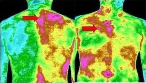 医用红外热像仪应用于早期恶性肿瘤诊断
